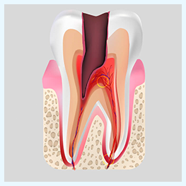 Лечение каналов зуба при пульпите: консервативный и хирургический методы