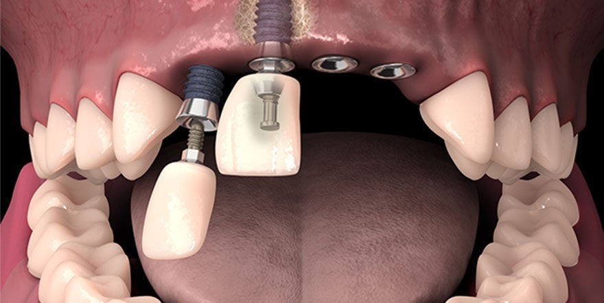 Почему Болят зубы После Имплантации