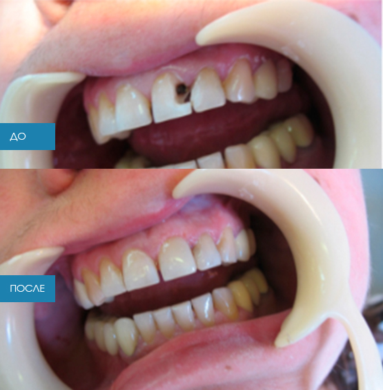 Кариес зубов фото до и после